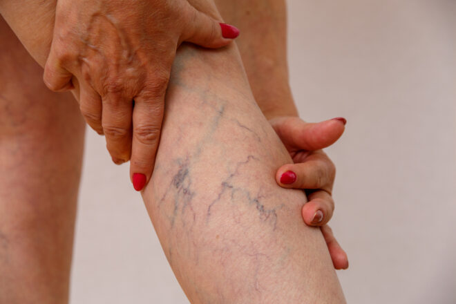 The help of compression socks for varicose veins